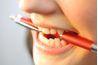 Mordre dans des objets durs peut se fissurer ou ébrécher les dents.