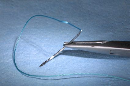 L'utilisation de la maille à travers des incisions dans la paroi vaginale a donné lieu à des complications graves.