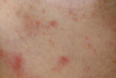 Dermatite, le psoriasis, l'eczéma, les brûlures et les blessures de la peau endommagent souvent les cheveux.