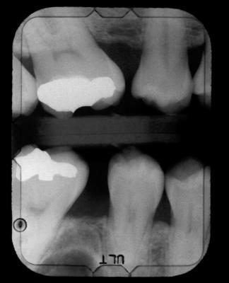 Dental X-Ray montrant cavités.