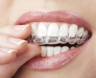 L'ingrédient actif dans des bandes de blanchiment blanchit vos dents pour une couleur plus blanche.