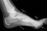 Un X-Ray peut être nécessaire pour diagnostiquer la cause sous-jacente de la douleur au pied.