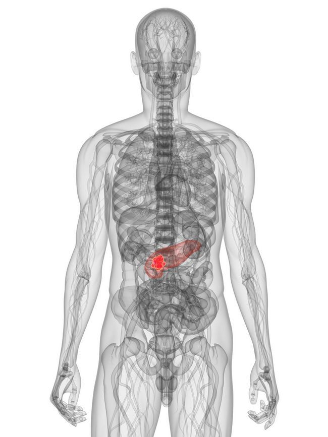 Une tumeur du pancréas peut exercer une pression sur les nerfs de l'abdomen à mesure qu'il grandit.