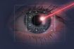 Une deuxième intervention chirurgicale est généralement nécessaire de repositionner la lentille artificielle et corriger les problèmes de vision.