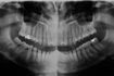 Radiographie panoramique des dents humaines et de la mâchoire