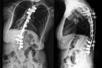 Radiographies de la colonne vertébrale avec scoliose.