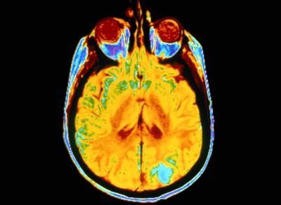 Scanner du cerveau montrant le cancer