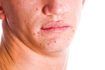L'acné est un effet à court terme.