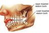 Les dents de sagesse qui poussent dans un angle généralement besoin d'être extrait (WebMD)