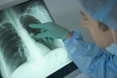Docteur pointant vers les poumons avec le signe du cancer