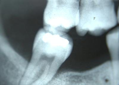 Un dentiste généraliste sera probablement fermer, mettre une obturation temporaire sur la dent et envoyer le patient à un endodontiste qui se spécialise dans ces problèmes.