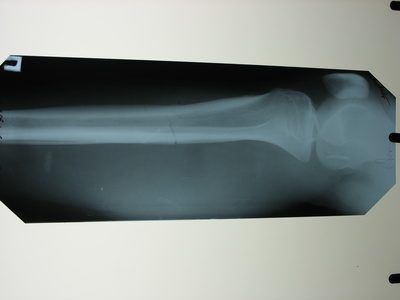 Comme on le voit dans cette rayons X, l'articulation du genou présente des arrondis. Le tibia est l'os de la tête proximale plus grande.