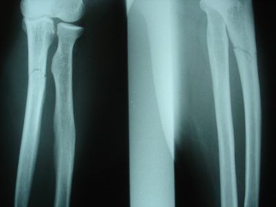 Dans une fracture de l'os médial, la pause aura lieu au milieu d'un os long.