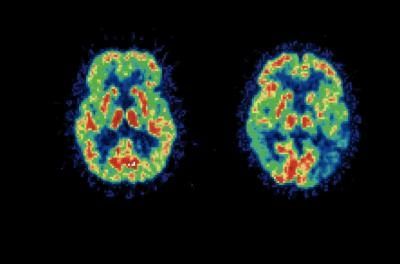PET cerveau comparaison de résultat du scan