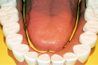 La zone ou de mâcher zone supérieure des dents est connu comme la zone occlusale